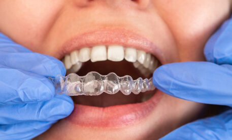 The Future is Clear: Why Spark Aligners Are Transforming Smiles in Manchester