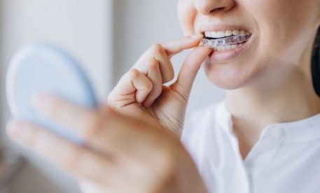 How Spark Aligners Correct Misalignment Without Metal Braces