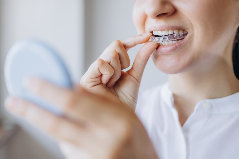 Spark Aligners Correct Misalignment