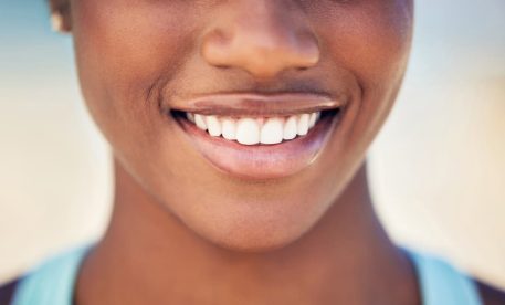 Porcelain vs Composite Veneers: What’s the Difference?