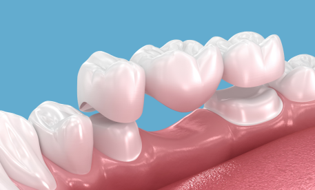 Dental Crowns, Bridges and Dentures in Didsbury: Dr Neehal Shah on Restoring Your Smile