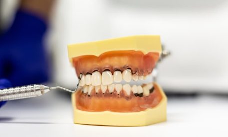 Gingivitis vs Periodontitis: What Is the Difference?