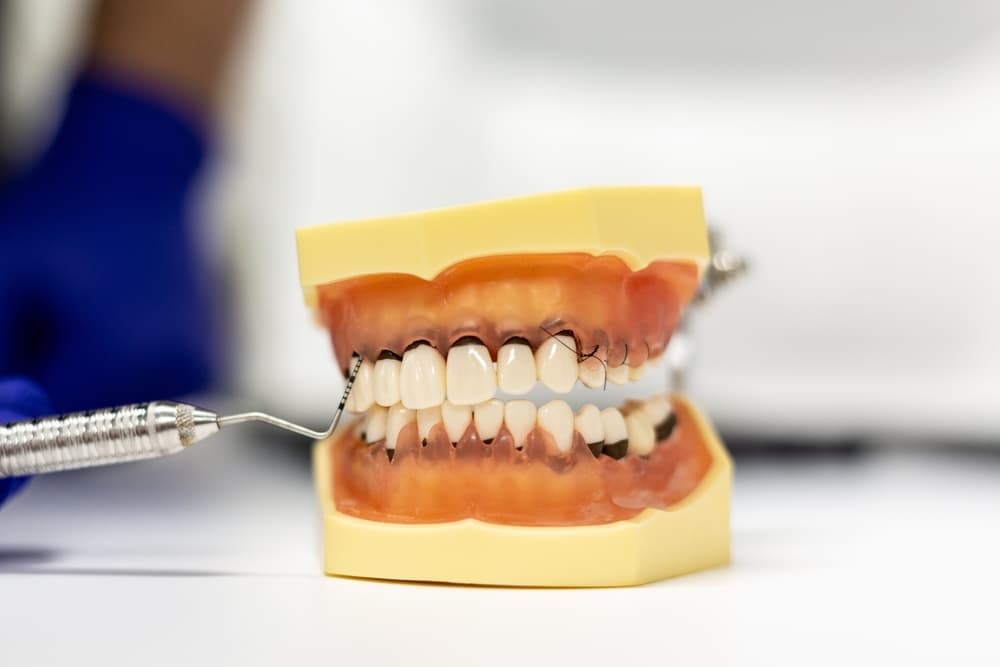 bleeding gums