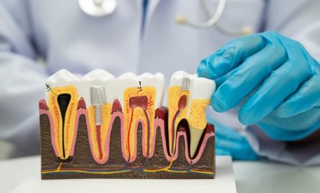 What to Expect After Root Canal Treatment