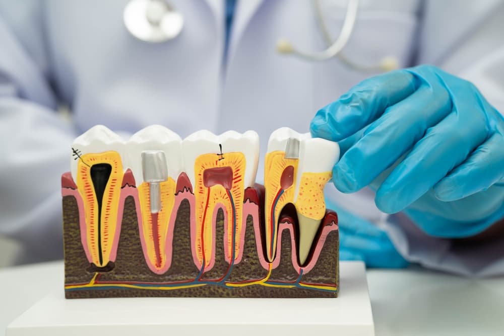 root canal treatment